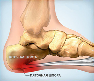 Крем FitoHeel от пяточной шпоры купить в Магнитогорске Fitoheel крем от пяточной шпоры